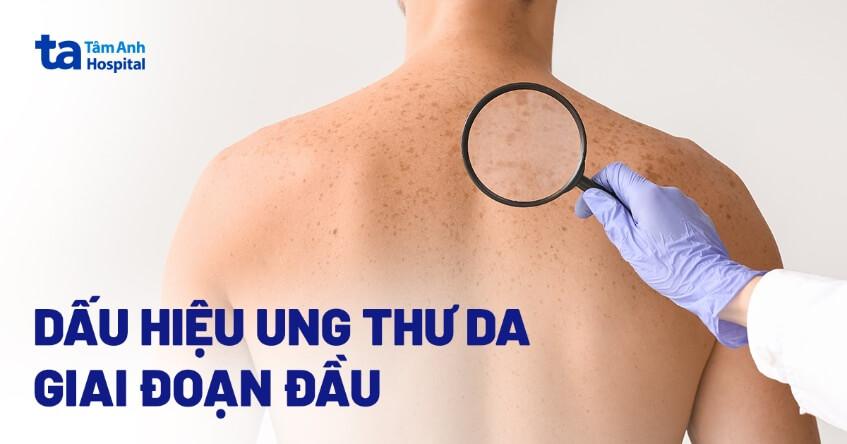 ung thư da giai đoạn đầu