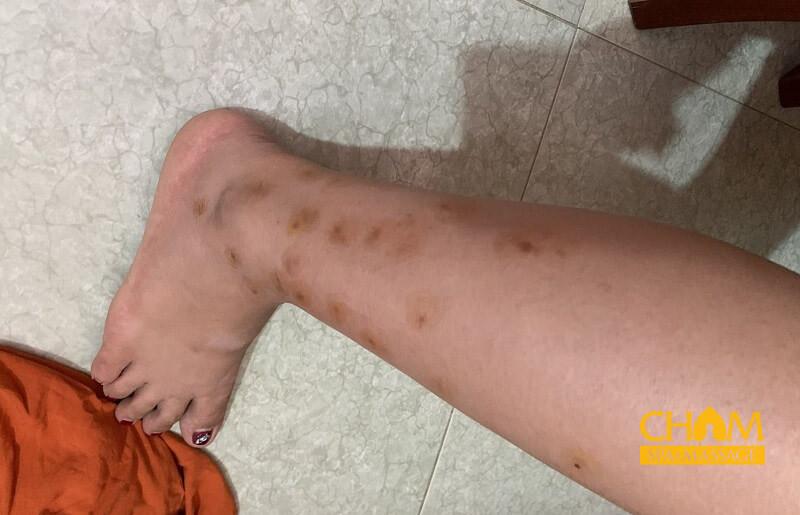 Nguyên nhân khiến chân bị sẹo thâm Cham Spa & Massage