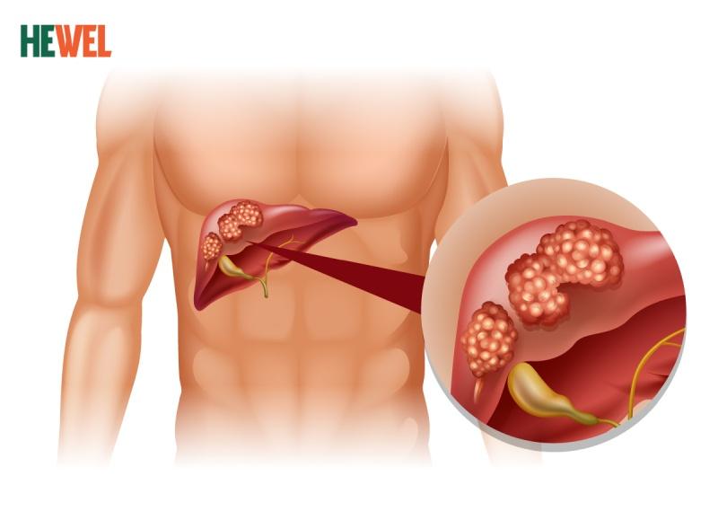 Chăm sóc bệnh nhân ung thư những ngày cuối đời