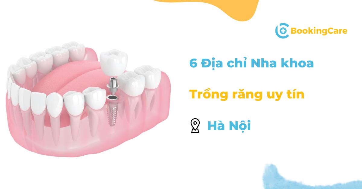 địa chỉ nha khoa trồng răng tại Hà Nội