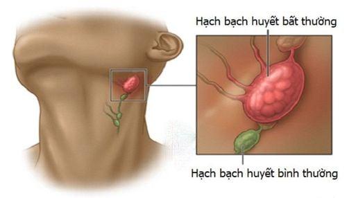 nổi hạch bạch huyết