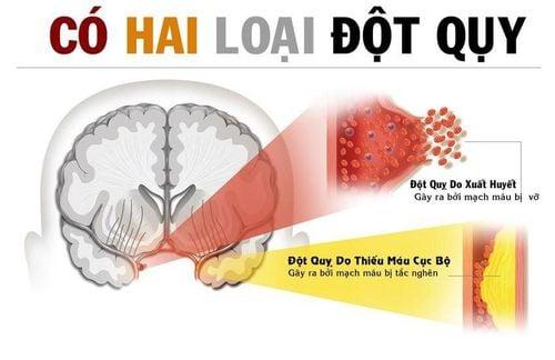 Đột quỵ não - Những điều cần biết