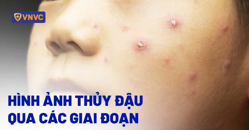 42 hình ảnh thủy đậu qua các giai đoạn và biến chứng rõ nét