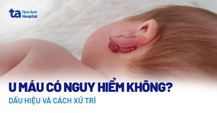 U máu có nguy hiểm không? Xử trí như thế nào khi có dấu hiệu mắc bệnh?