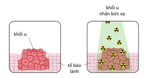 Xạ trị giúp tiêu diệt tế bào ung thư