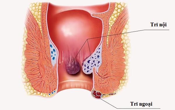 ĐIỀU TRỊ BỆNH TRĨ CẦN LƯU Ý NHỮNG GÌ?