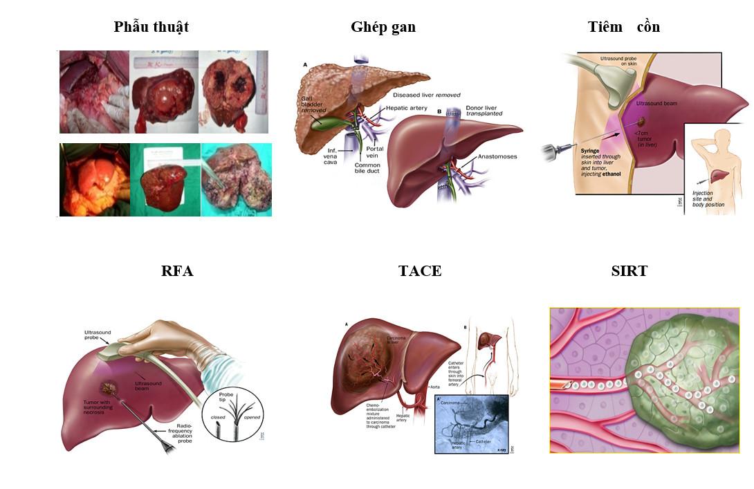 Ung thư gan giai đoạn sớm có chữa được không