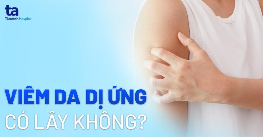 viêm da dị ứng