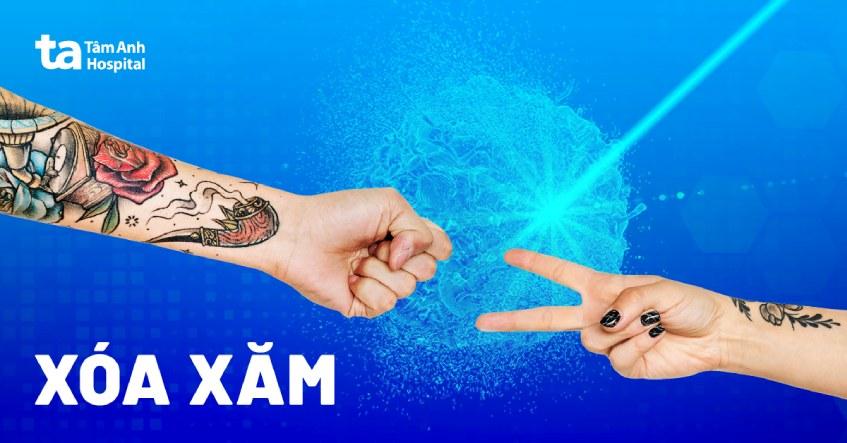 Xóa xăm là gì? Có đau không? Lưu ý cần biết trước khi lựa chọn