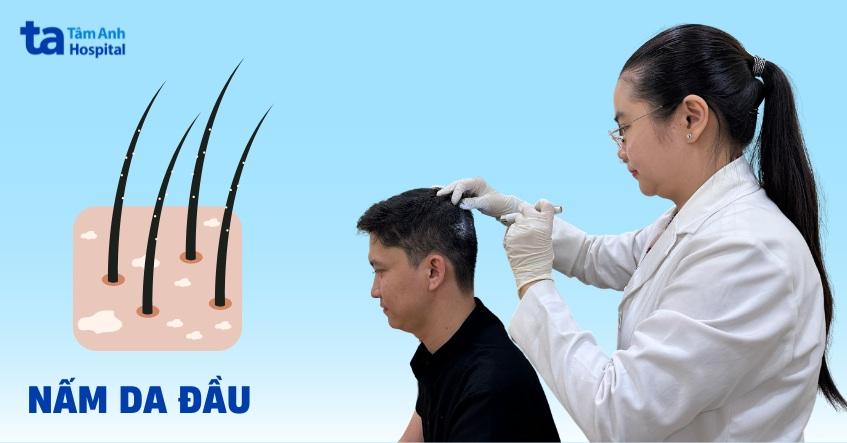 Nấm da đầu: Nguyên nhân, dấu hiệu, chẩn đoán và phòng ngừa