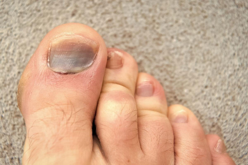 Cách chữa móng chân bị bầm tím giúp vết thương nhanh hồi phục